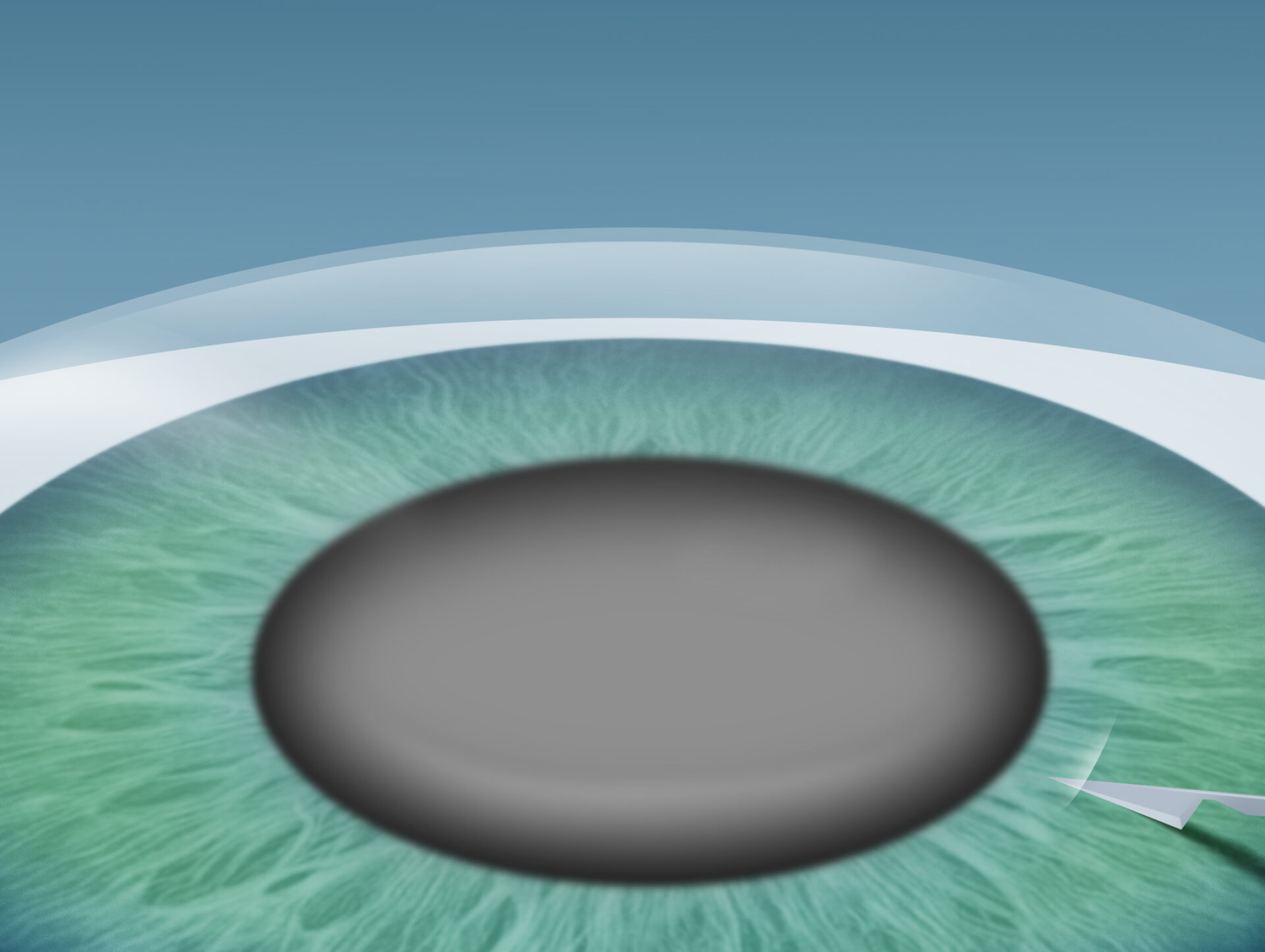 Grauer Star (Katarakt) Behandlung im Augenkompetenz Zentrum Bremerhaven