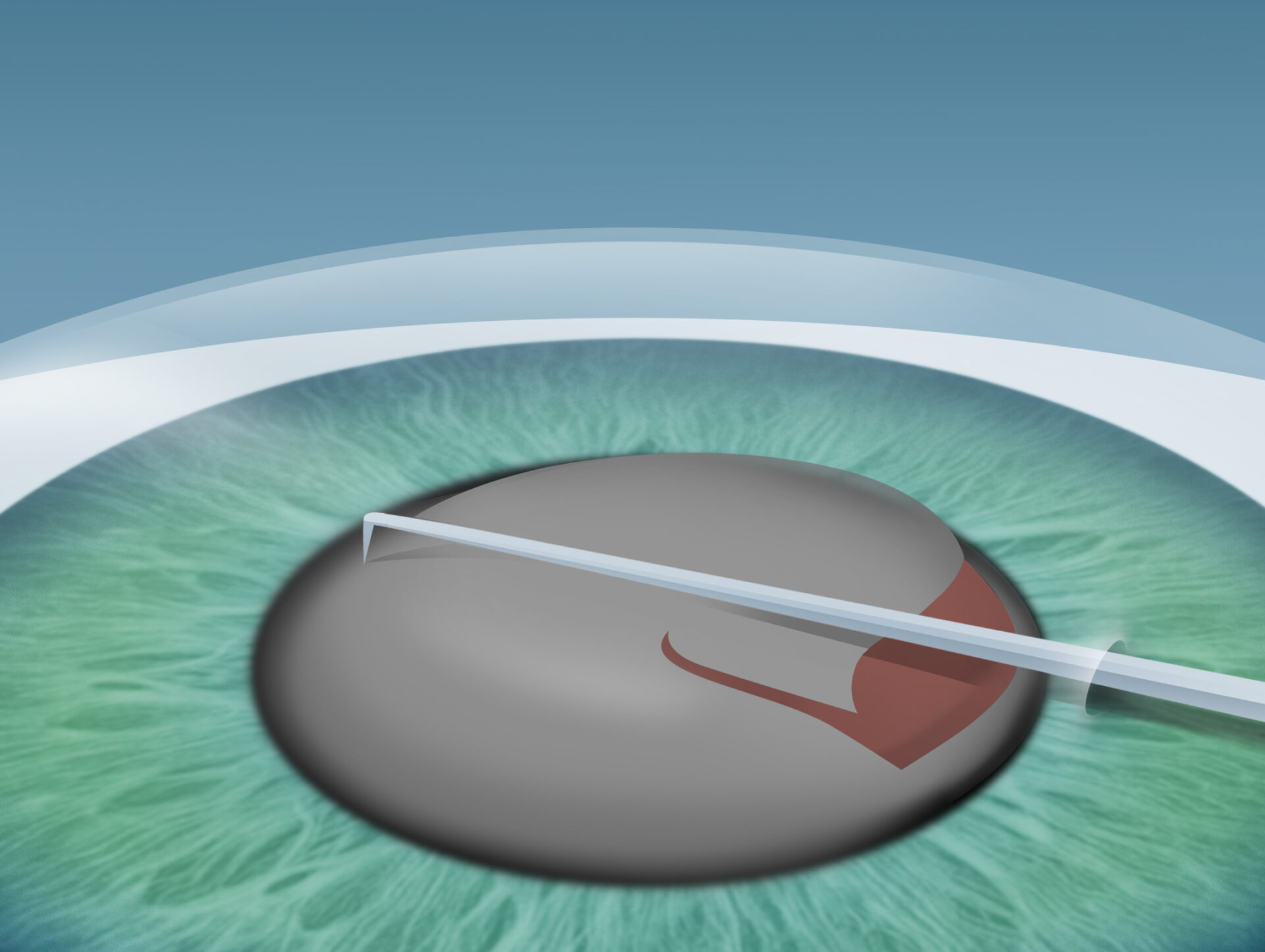 Grauer Star (Katarakt) Behandlung im Augenkompetenz Zentrum Bremerhaven