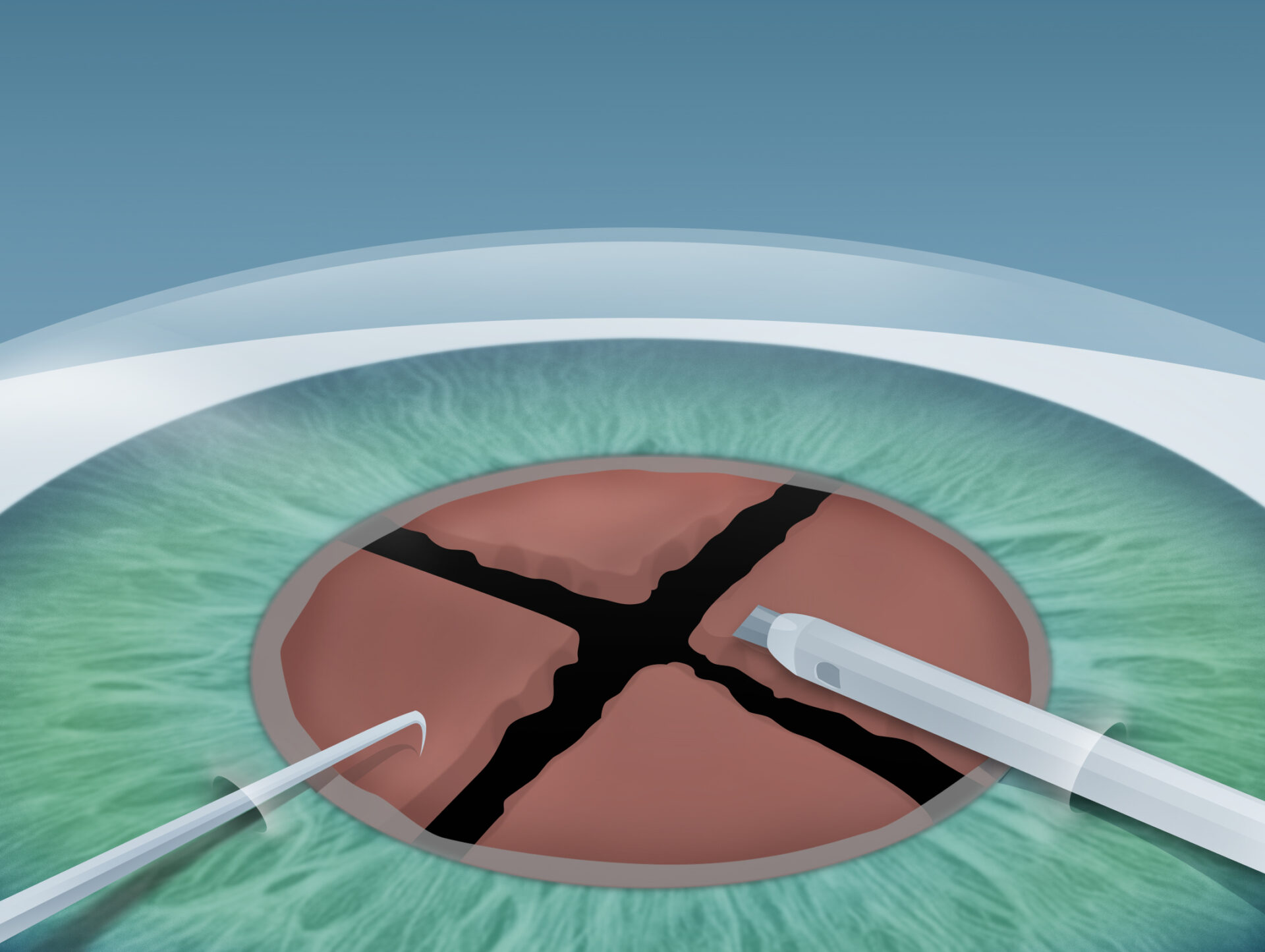 Grauer Star (Katarakt) Behandlung im Augenkompetenz Zentrum Bremerhaven