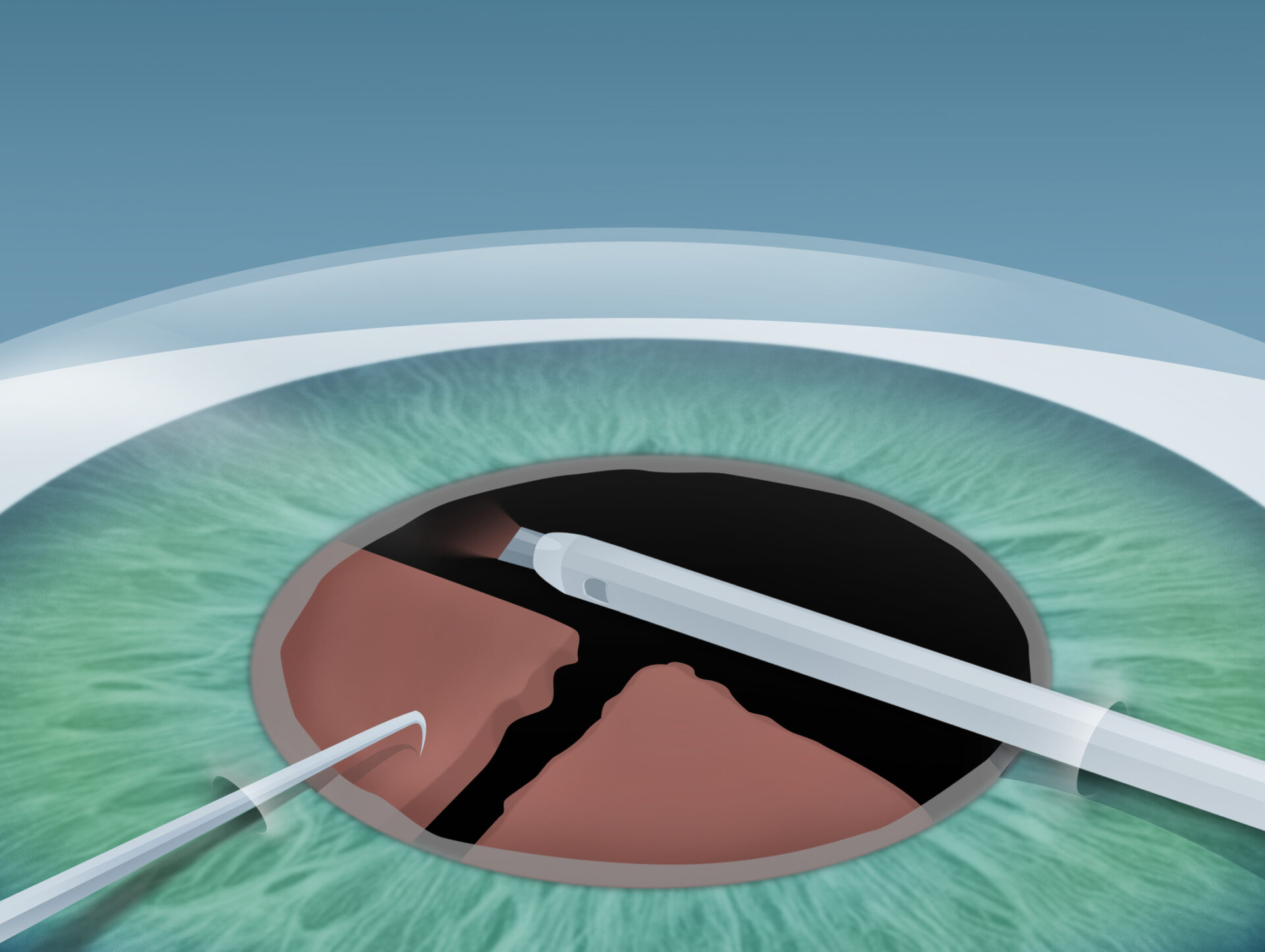 Grauer Star (Katarakt) Behandlung im Augenkompetenz Zentrum Bremerhaven