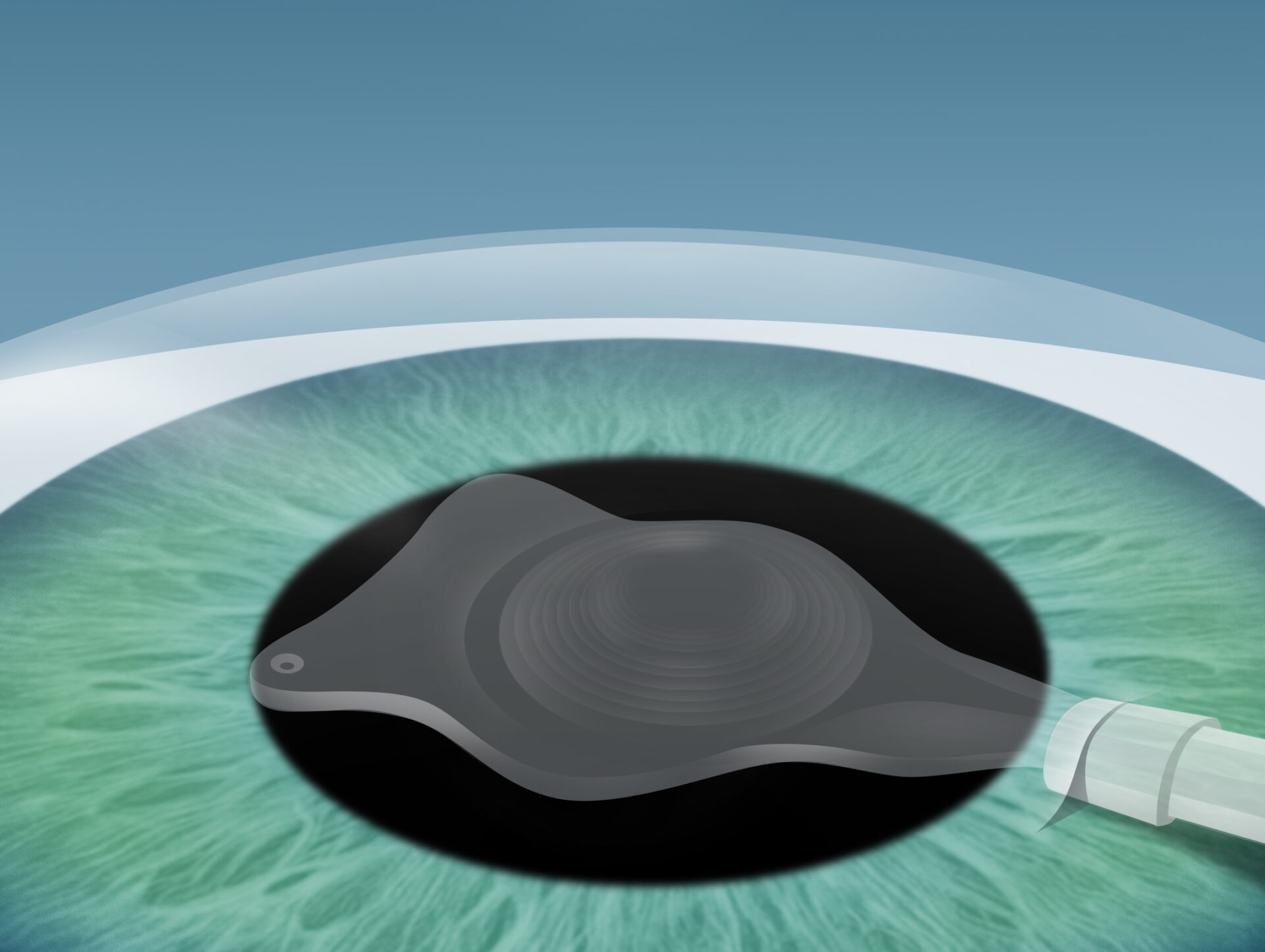 Grauer Star (Katarakt) Behandlung im Augenkompetenz Zentrum Bremerhaven