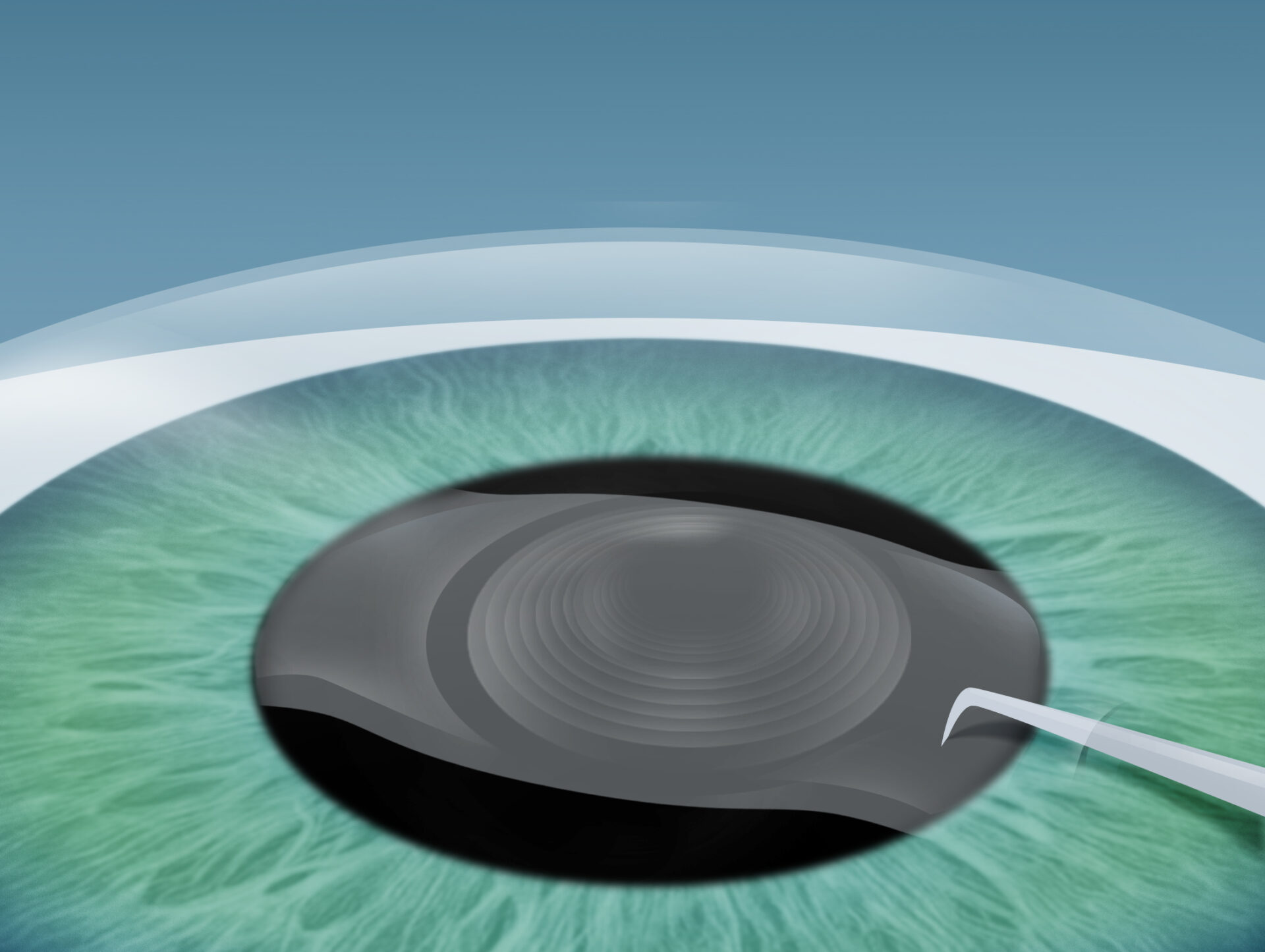 Grauer Star (Katarakt) Behandlung im Augenkompetenz Zentrum Bremerhaven